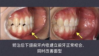 成人矫正牙成功案例视频,成人矫正牙成功案例视频集锦